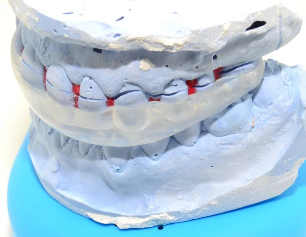 Dental skena Royaltyfria Stockfoton