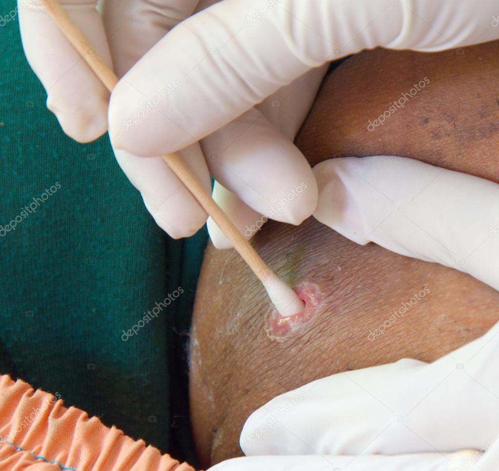 Abszess entwässern. — Stockfoto © wellcom22 #51274615