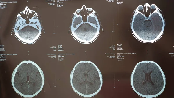 Ressonância magnética do cérebro Imagem De Stock