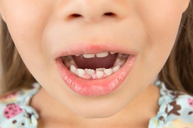 Open mouth of a little girl with calf's and permanent teeth clipart