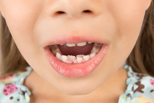 Boca aberta de uma menina com dentes de bezerro e permanentes — Fotografia de Stock