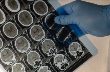 Mavi eldiven giyen beyin cerrahı insan kafasını gösteren CAT taramalarını tutuyor. Muayene, tedavi. Tamografi, MRI, X-ray
