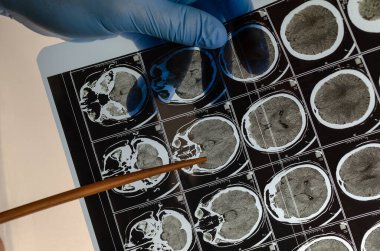 Mavi tıbbi eldiven giyen doktor bir insanın beyninin röntgenini işaret ediyor. Sağlık ve Tıp. Seçici Odaklanma.