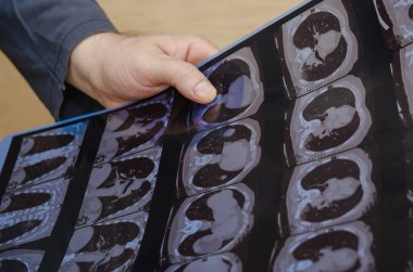 Bir adamın eli göğsünün tomografi taramasını tutuyor. Hastanenin radyoloji bölümündeki bir hastanın muayenesi. Covid-19 veya zatürree. Seçici odak.