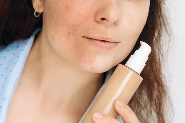 Girl Applies Tonal Corrective Cream Problematic Pigmentation Face — Foto de Stock