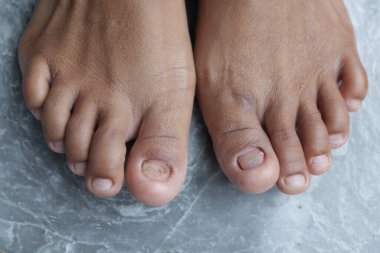 Kırık tırnaklar, onychocryptosis oyulmuş çiviler.