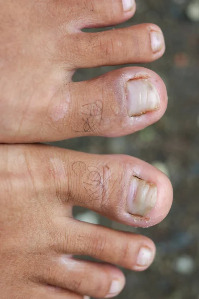 Broken nails, Onychocryptosis of ingrown nails