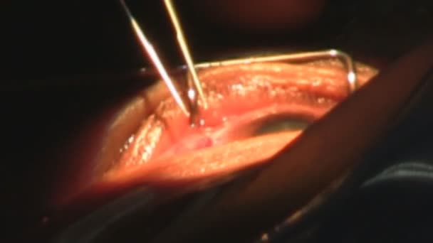 Cirurgia ocular — Vídeo de Stock