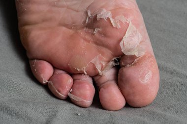 Bir ayağın derisi soyuluyor.