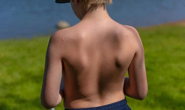 Skin Peeling Back Small Kid Being Sunburned — Stock Photo, Image
