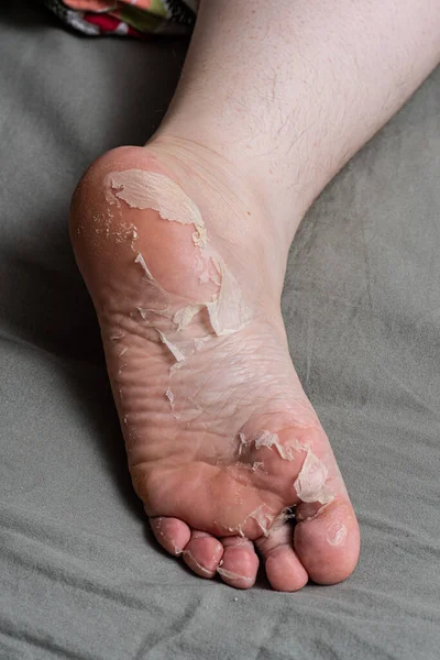 Skin peeling off a foot.