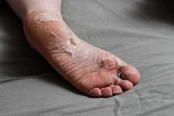 Skin peeling off a foot.