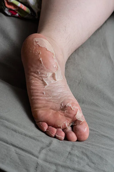 Skin peeling off a foot.