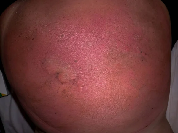 Man Severe Burn His Back Close — Stock Photo, Image