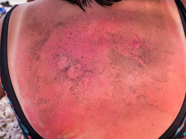 Sırtında ciddi yanıklar olan bir kadın. Kapat.. 