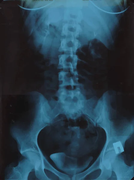 Realistische Lumbar wervelkolom röntgenfoto, bekkenbeenderen MRI scan foto. Vectorillustratie — Stockvector