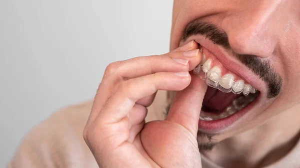 Mão Masculina Aplicando Aligner Dental Retentor Clínica Odontológica Para Tratamento — Fotografia de Stock