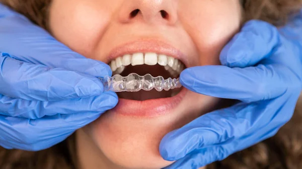 Dentist Gloves Applying Invisible Aligner Female Patient Teeth Modern Clinic — Stock Photo, Image