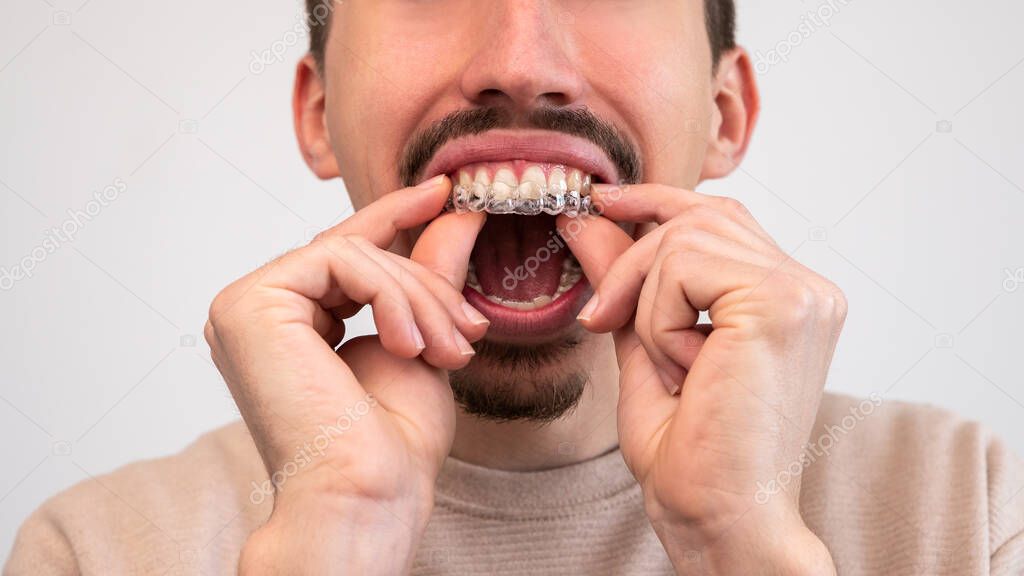 Male hand applying dental aligner retainer of dental clinic for beautiful teeth treatment. Orthodontic removable straighteners in dentist office.