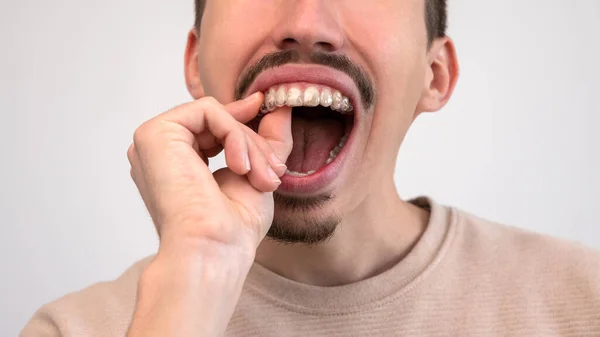 Biały Młodzieniec Dopasowuje Umieszcza Niewidzialny Silikonowy Korektor Zębów Mężczyzna Ręka — Zdjęcie stockowe