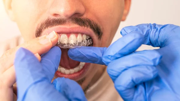 Orthodontist doctor in gloves putting silicone invisible transparent braces on man\'s teeth in dentist clinic, mouth with mustache closeup view. Correcting teeth treatment and cure in dentistry.