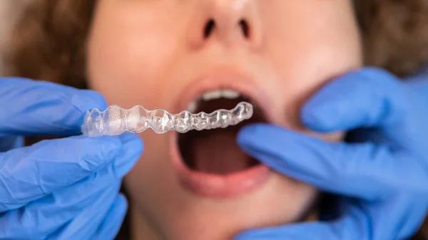 Orthodontist doctor in gloves putting silicone invisible transparent braces on woman's teeth in dentist clinic, mouth closeup view. Correcting teeth treatment and cure in dentistry.