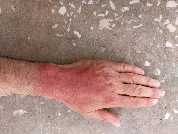 Mãos Bronzeadas Queima Pele Mãos Vermelhas Pele Humana Danificada Protecção — Fotografia de Stock