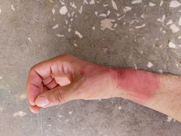 Zongebruinde Handen Huidverbranding Rode Handen Beschadigde Menselijke Huid Bescherming Tegen — Stockfoto