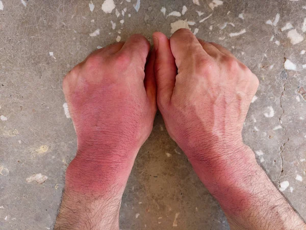 Opalone Słońcem Ręce Skóra Płonie Czerwone Ręce Uszkodzona Ludzka Skóra — Zdjęcie stockowe