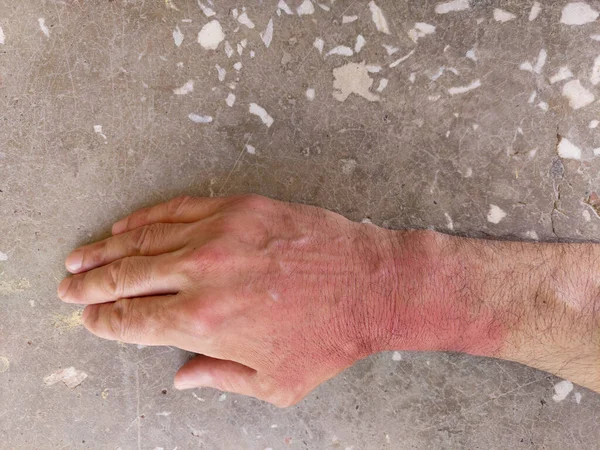 Zongebruinde Handen Huidverbranding Rode Handen Beschadigde Menselijke Huid Bescherming Tegen — Stockfoto