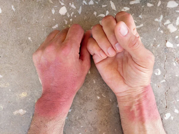 Mãos Bronzeadas Queima Pele Mãos Vermelhas Pele Humana Danificada Protecção — Fotografia de Stock