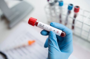 Laboratuvar: Kan örneği sistemik lupus eritematosus SLE pozitif.