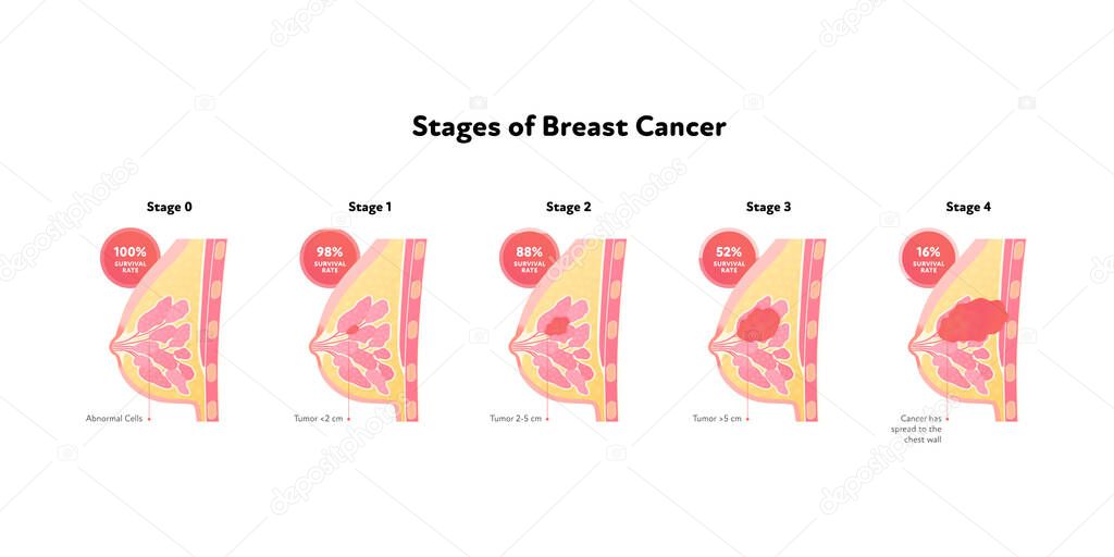 Human breast cancer anatomy diagram. Vector flat medical illustration. Side view. Survival rate. Stages of tumor disease isolated on white background. Design for healthcare, education, oncology.