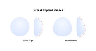 Kadın göğüs cerrahisi bilgi grafiği. Vektör düz tıbbi illüstrasyon. Beyaz arkaplanda mavi yuvarlak ve gözyaşı damlası implant tipi.