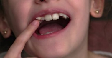 Genç bir kız gülümser ve çarpık dişlerini gösterir. Ağız yakın plan..