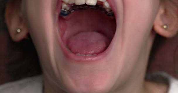 Młoda Dziewczyna Uśmiecha Się Pokazuje Krzywe Zęby Zbliżenie Ust — Wideo stockowe