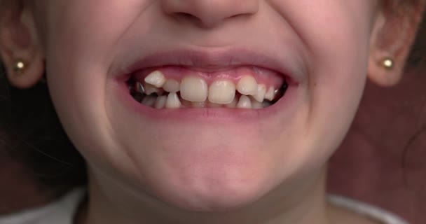 Mladá Dívka Usměje Ukáže Své Křivé Zuby Detailní Záběr Úst — Stock video