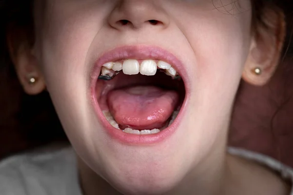 Młoda Dziewczyna Uśmiecha Się Pokazuje Krzywe Zęby Zbliżenie Ust Obraz Stockowy