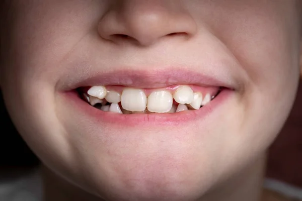 Młoda Dziewczyna Uśmiecha Się Pokazuje Krzywe Zęby Zbliżenie Ust Obrazy Stockowe bez tantiem