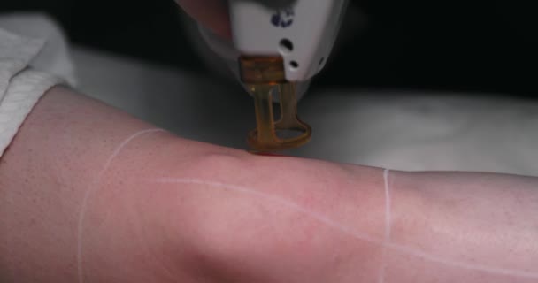 Close Footage Female Client Leg Receiving Pulses Laser Light Destroying — Vídeos de Stock