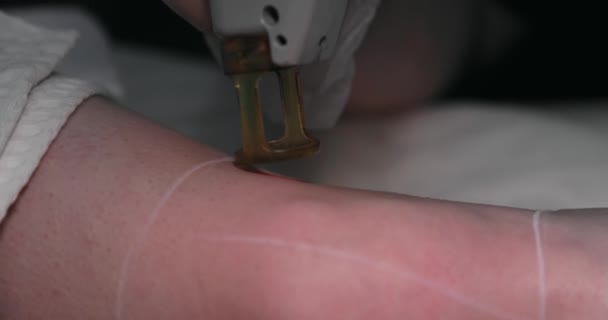 Close Footage Female Client Leg Receiving Pulses Laser Light Destroying — Stockvideo