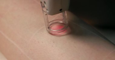 Close-up footage of a female client's leg receiving pulses of laser light destroying a hair follicle. Laser hair removal procedure in a beauty salon. slow motion.
