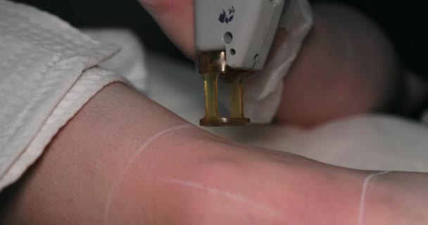 Close Footage Female Client Leg Receiving Pulses Laser Light Destroying — ストック動画