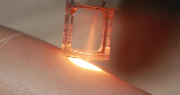 Close Footage Female Client Leg Receiving Pulses Laser Light Destroying — Wideo stockowe
