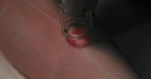 Close Footage Female Client Leg Receiving Pulses Laser Light Destroying — ストック動画