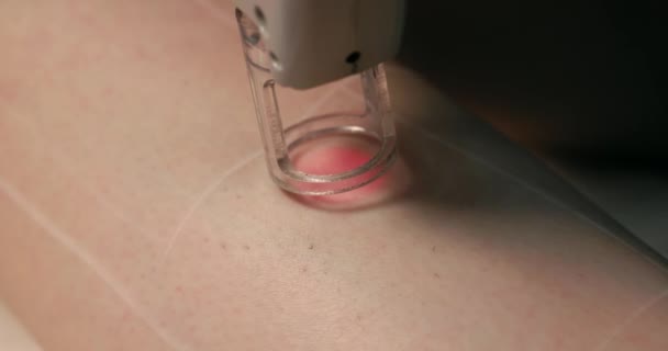Close Footage Female Client Leg Receiving Pulses Laser Light Destroying — ストック動画