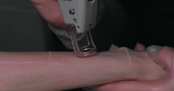 Close Footage Female Client Hand Receiving Pulses Laser Light Destroying — Vídeo de stock