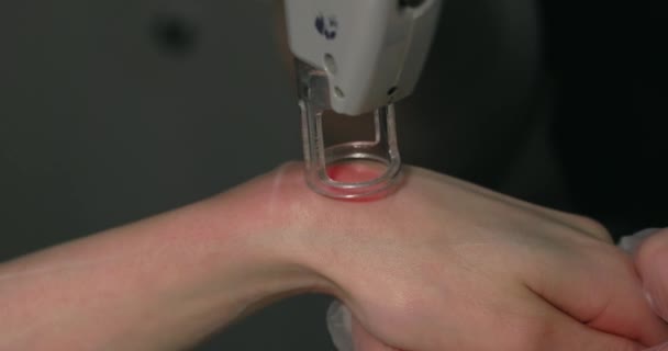 Close Footage Female Client Hand Receiving Pulses Laser Light Destroying — Vídeos de Stock