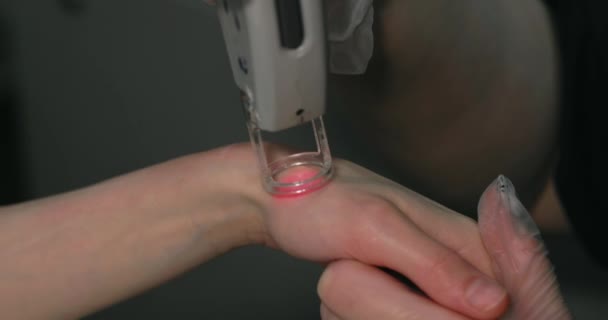 Close Footage Female Client Hand Receiving Pulses Laser Light Destroying — Vídeo de Stock