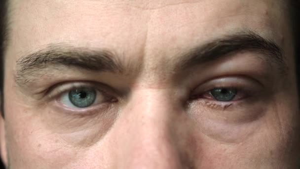 Крупный план резкого кровоизлияния красного глаза мужчины, пострадавшего от конъюнктивита — стоковое видео